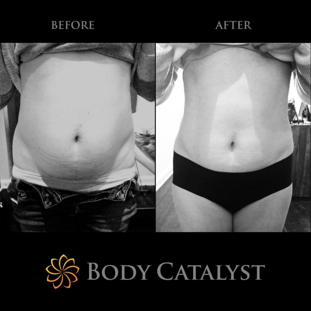 Fat Cavitation - 6 - Body Catalyst