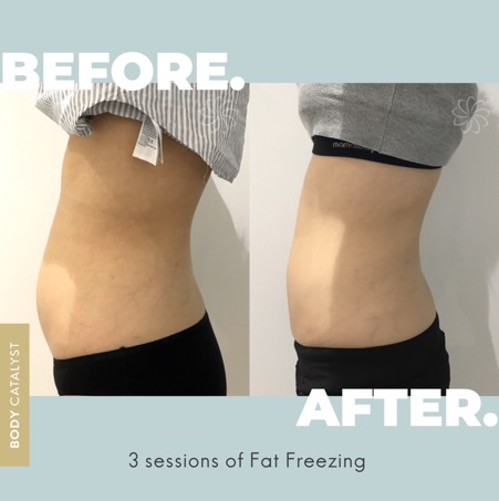 Cryolipolysis Fat Freezing Transformation