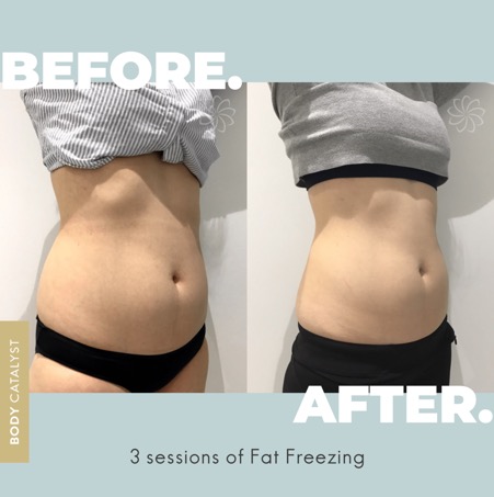 Cryolipolysis-FatFreezing-Transformation